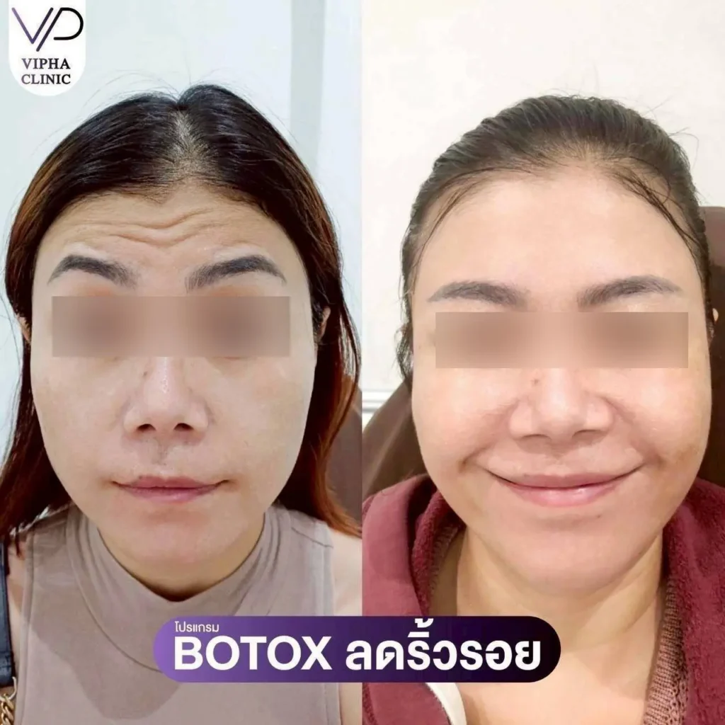 โบท็อกซ์ริ้วรอย 01