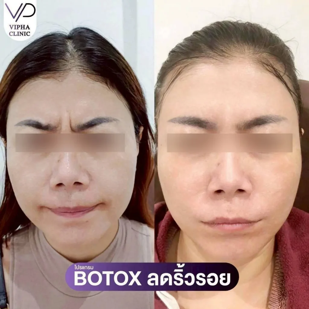 โบท็อกซ์ริ้วรอย 02