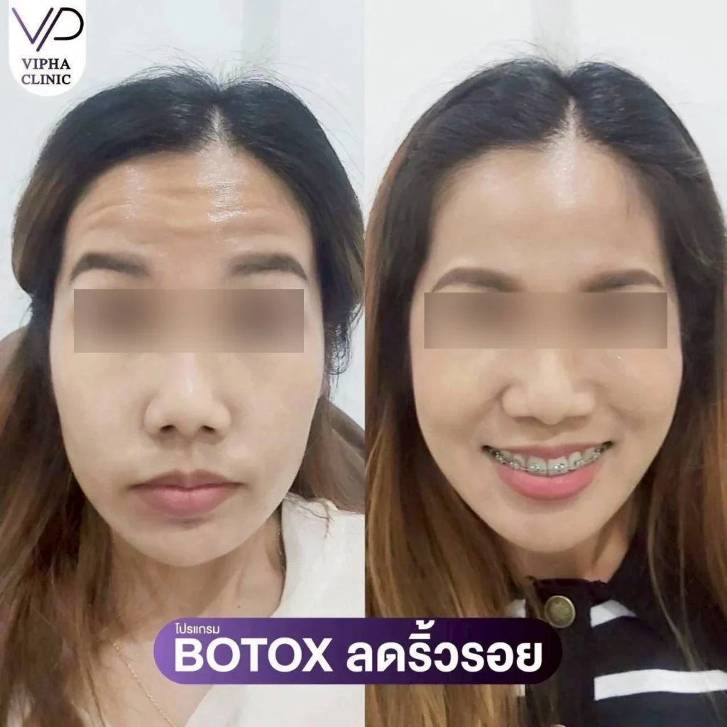 โบท็อกซ์ริ้วรอย 03