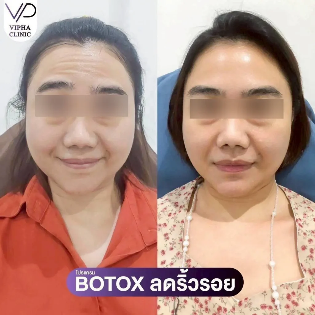 โบท็อกซ์ริ้วรอย 05