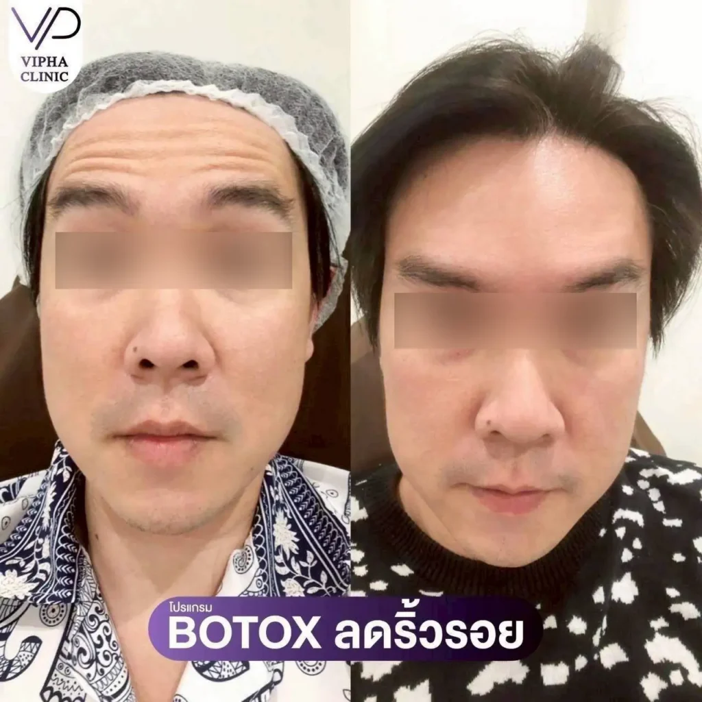 โบท็อกซ์ริ้วรอยผู้ชาย