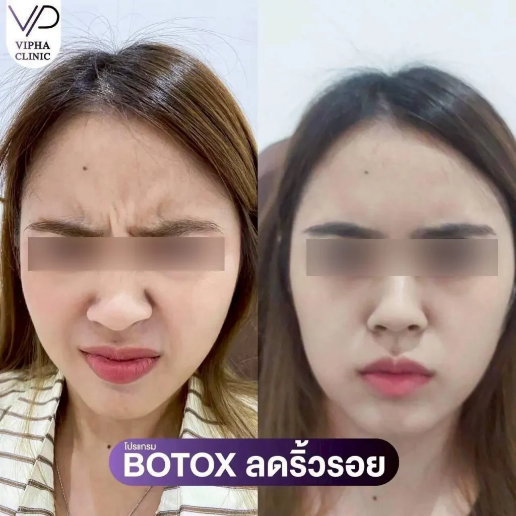 โบท็อกซ์ริ้วรอย 04